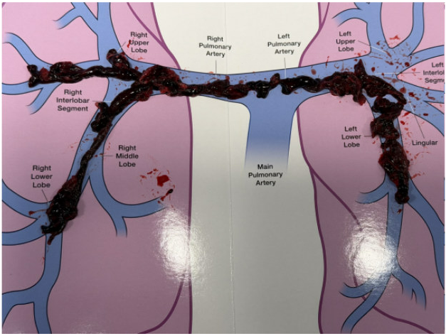 Blood clots removed during emergency thrombectomy, May 1 2026